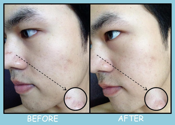 Rojukiss Acne Spotless Serum   ปราศจากสารรุนแรงที่อาจก่อให้เกิดการระคายเคืองและไม่มีส่วนผสมของสารที่ก่อให้เกิดการอุดตันสาเหตุหนึ่งที่ทำให้เกิดสิว  Non-Comedogenic No Paraben และ No Alcohol   ** ผลทดสอบความพึงพอใจในผู้หญิง 30 คน หลังทดลองใช้ 7 วัน โดย Innov8asia (Thailand) Limited ประเทศไทย ก.ค. 2561 
