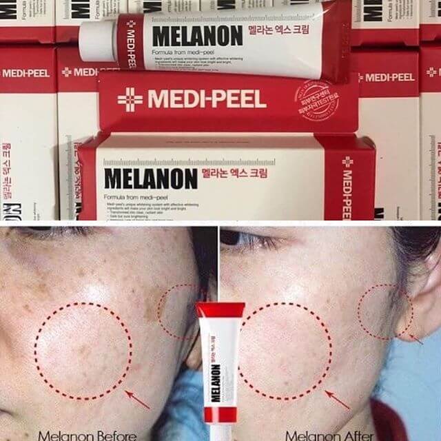 Medi-Peel Melanon x Cream 30 ml.  ไวเทนนิ่งอันดับ 1 จากเกาหลี ที่สาว ๆ ทั่วเอเชียต่างใช้แล้วชอบ ช่วยยับยั้งการสร้างเม็ดสีผิว อันเป็นต้นเหตุของฝ้า กระ จุดด่างดำ ช่วยปรับผิวให้ขาวใสอย่างเป็นธรรมชาติ และให้ความชุ่มชื่นแก่ผิว  ให้ผิวเรียบเนียน ชุ่มชื้นสุขภาพดี