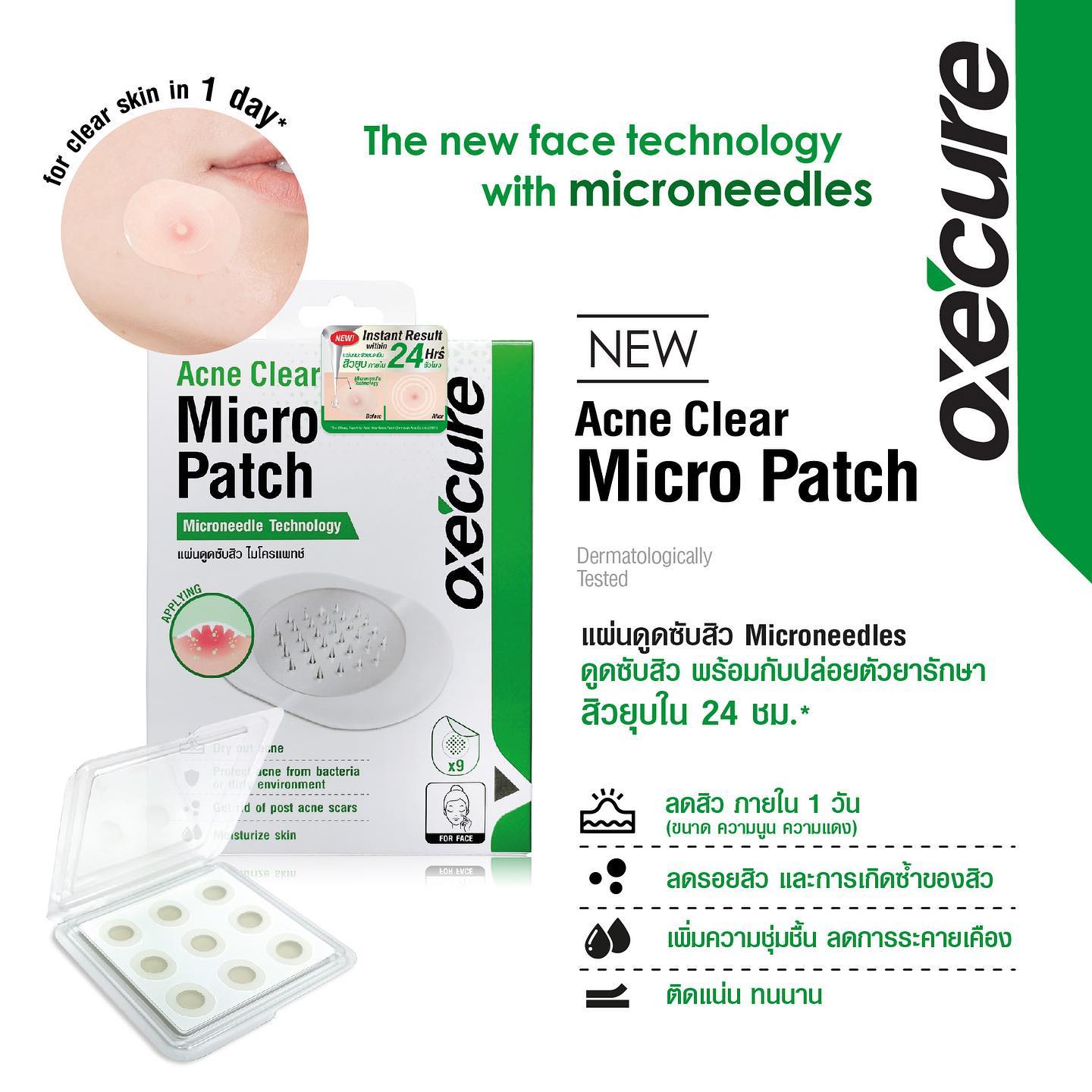 OXE'CURE Acne Clear Micro Patch 9ชิ้น/กล่อง แผ่นแปะสิวนวัตกรรมใหม่ด้วยเทคโนโลยี “self-dissolve Microneedles” เข็มเล็กๆที่อัดแน่นด้วยสารสกัดสำหรับรักษาปัญหาสิวที่ต้นเหตุ