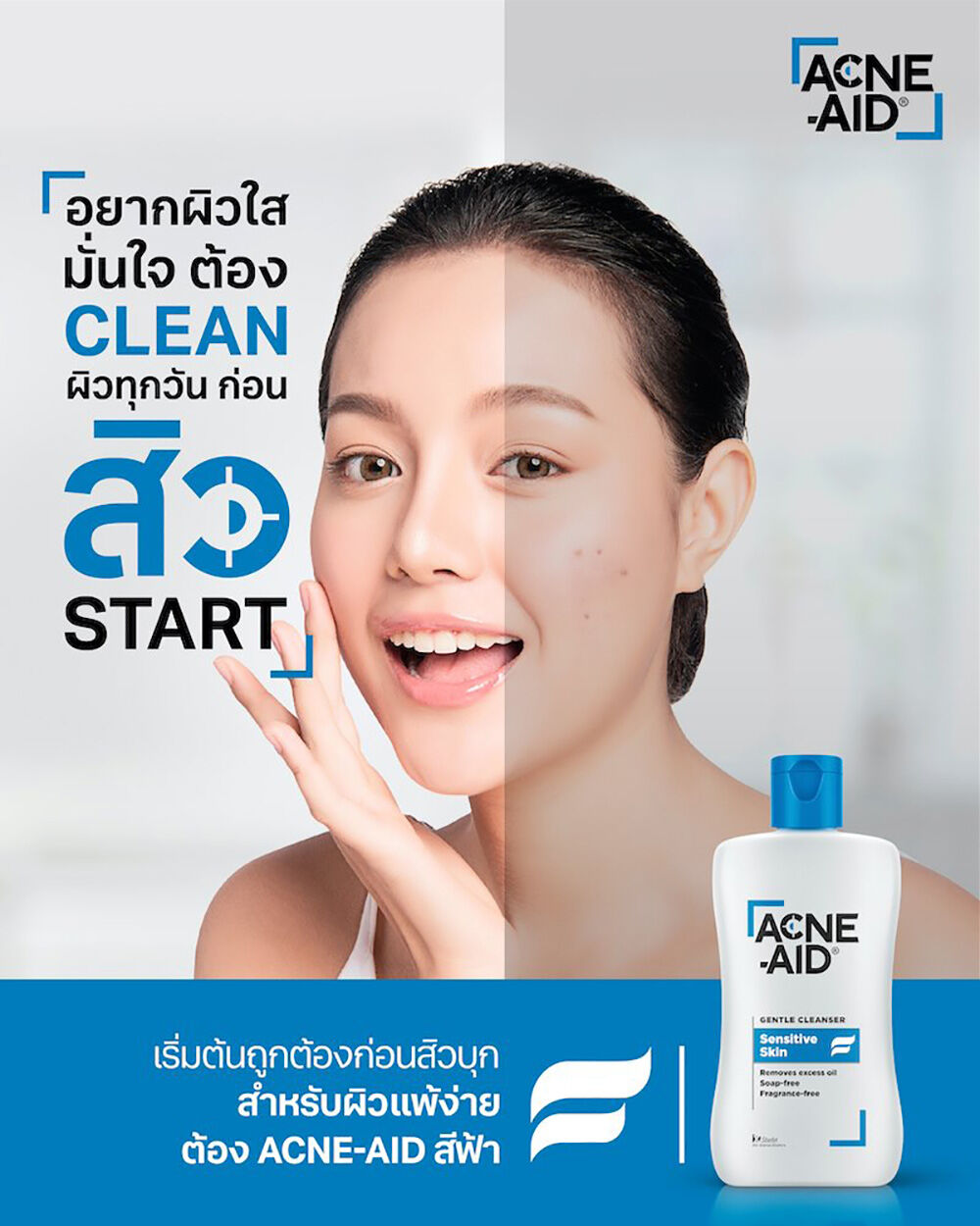 Acne-Aid Gentle Cleanser สีฟ้า ผิวบอบบางแพ้ง่าย