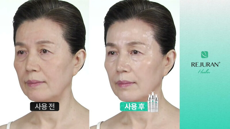 REJURAN Turnover Ampoule Before After