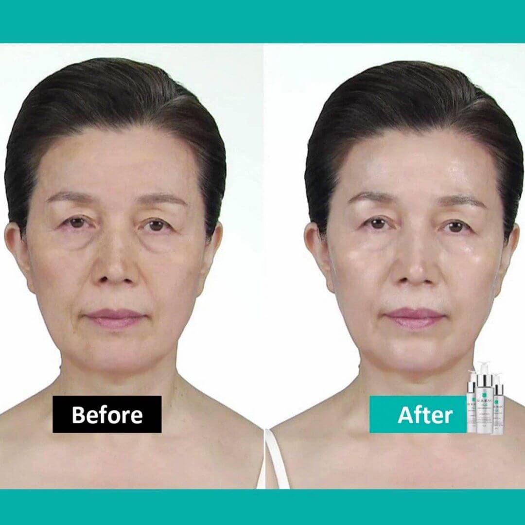 REJURAN Turnover Ampoule  Before After