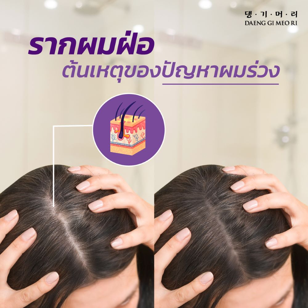 DAENG-GI-MEO-RI Shampoo 500 ml (Jingi Anti-Hair Loss) 500ml,DAENG-GI-MEO-RI, DAENG-GI-MEO-RI แชมพู , DAENG-GI-MEO-RI ลดผมร่วง , DAENG-GI-MEO-RI รีวิว , แชมพูลดผมร่วง  